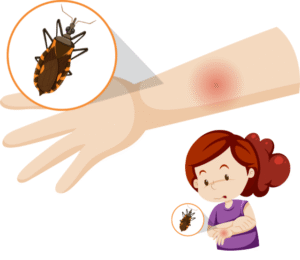 Chagas Disease in Sugar Land | Kissing bug